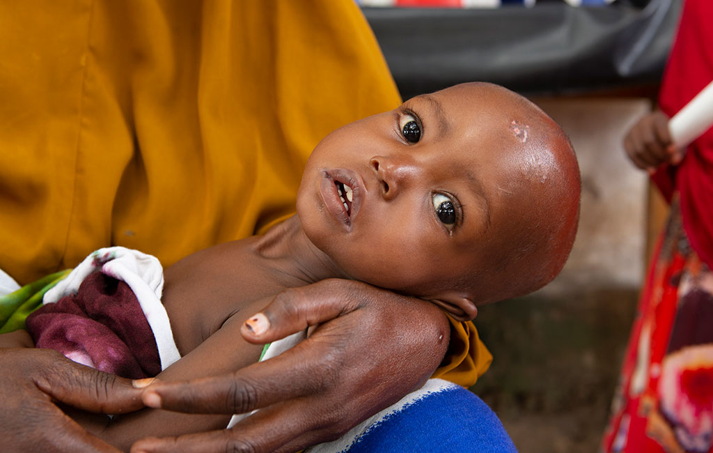 Mohamed after being admitted to an Action Against Hunger treatment centre in Mogadishu, Somalia.