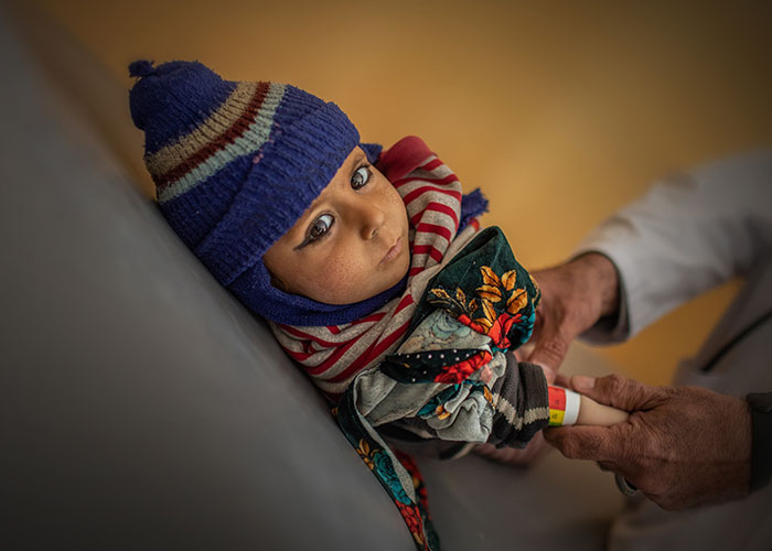 A child is screened for malnutrition in Afghanistan.