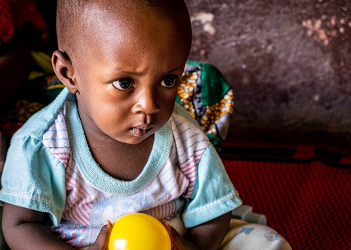 A child with disabilities caused by malnutrition in Central African Republic.