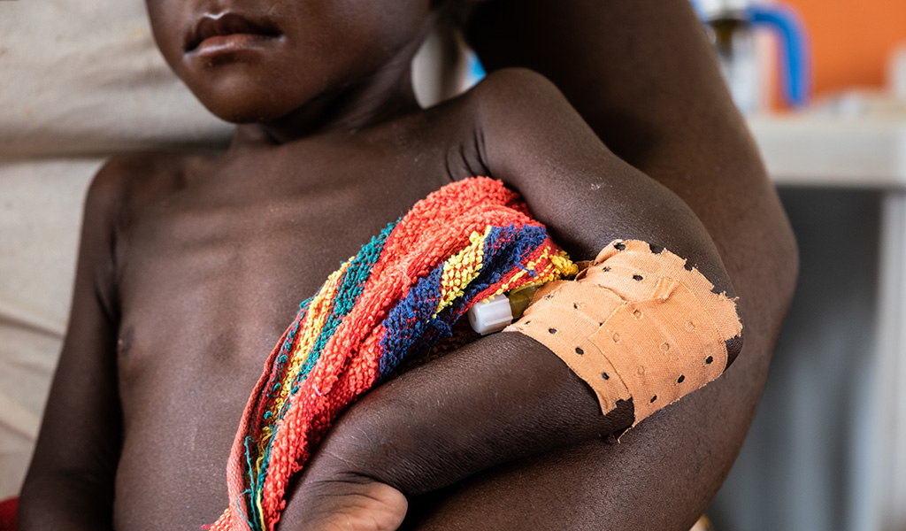 A child being treated for severe malnutrition I'v