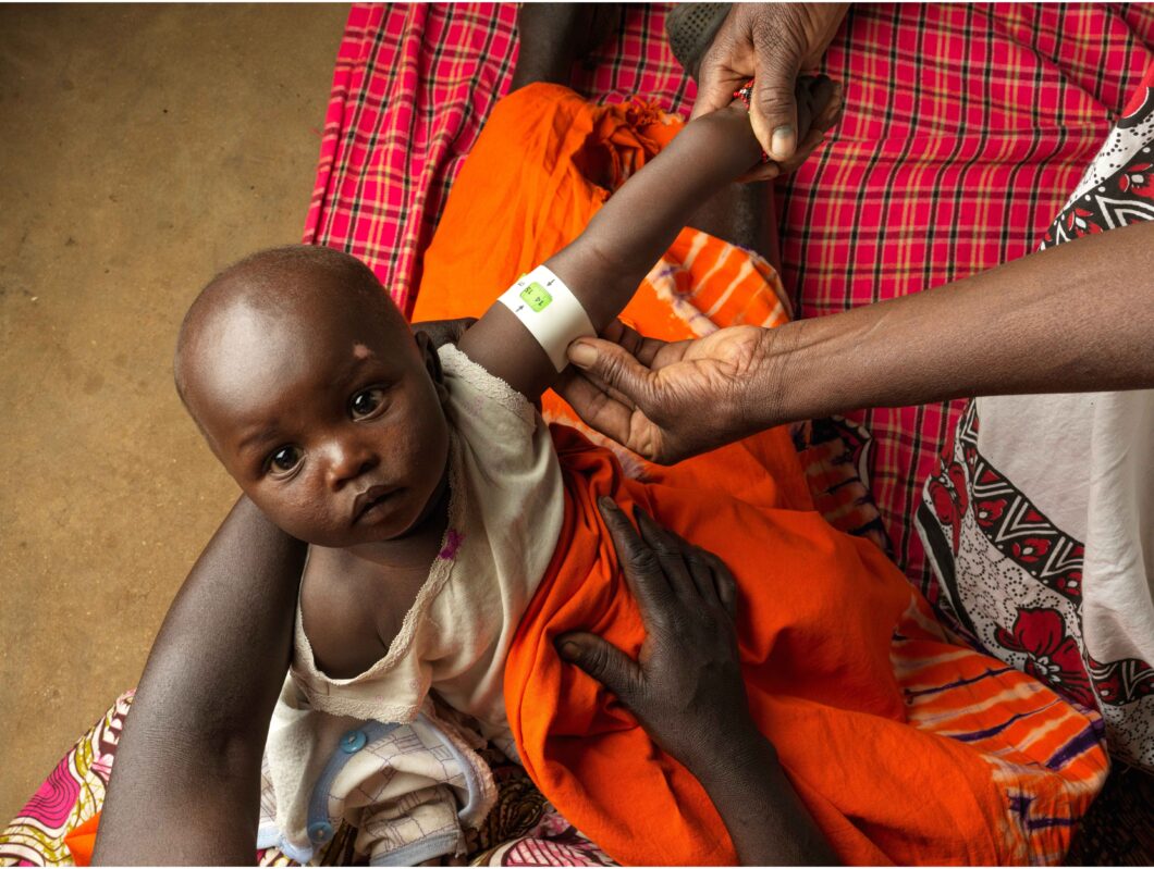 A young child looks at the camera while receiving malnutrition treatment.