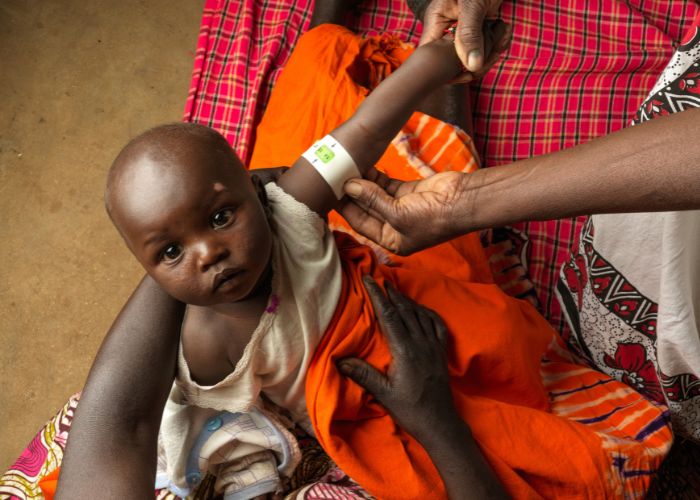 A young child looks at the camera while being treated for malnutrition